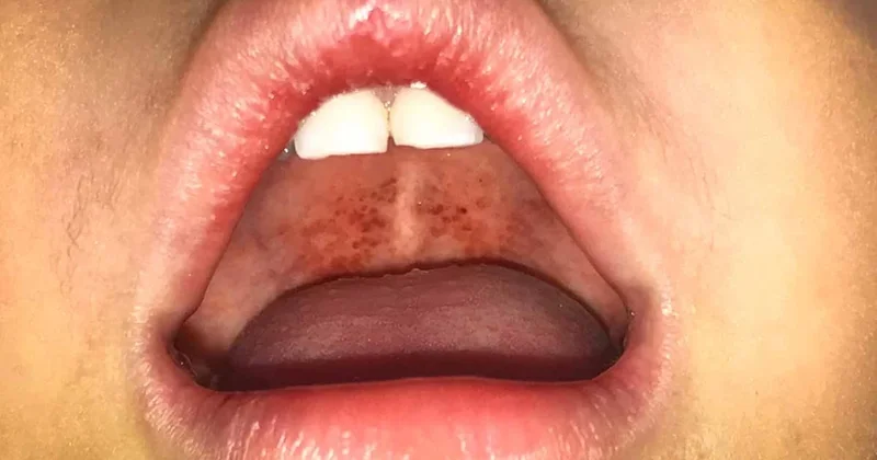 80 yıl sonra korkunç bir hastalık ortaya çıktı! Sözcü Gazetesi