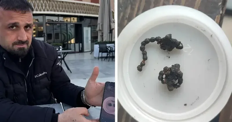 Rize de burnundan zincir parçası çıkarılan minik kız sağlığına kavuştu Gündem Haberleri