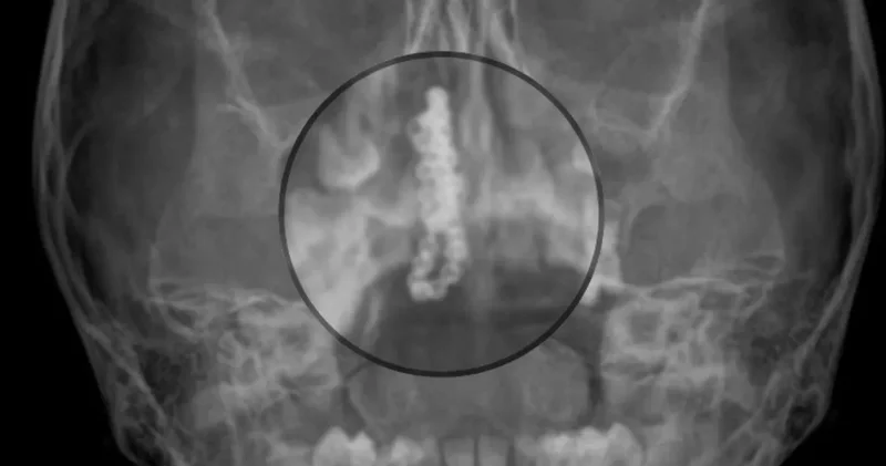 5 yaşındaki çocuğun burnundan çıkan doktorları hayrete düşürdü: Küçücük burna nasıl girmiş?