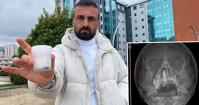 Şiddetli kanama ve akıntı şikayetiyle gitti: 5 yaşındaki Polen in 2 yıl boyunca burnundaymış! Bu nasıl gözden kaçabilir?