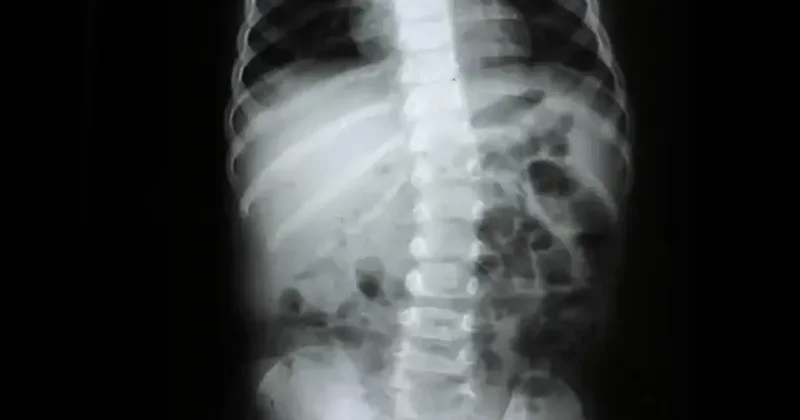 Omurga sağlığı için nelere dikkat edilmeli? Uzman isim açıkladı