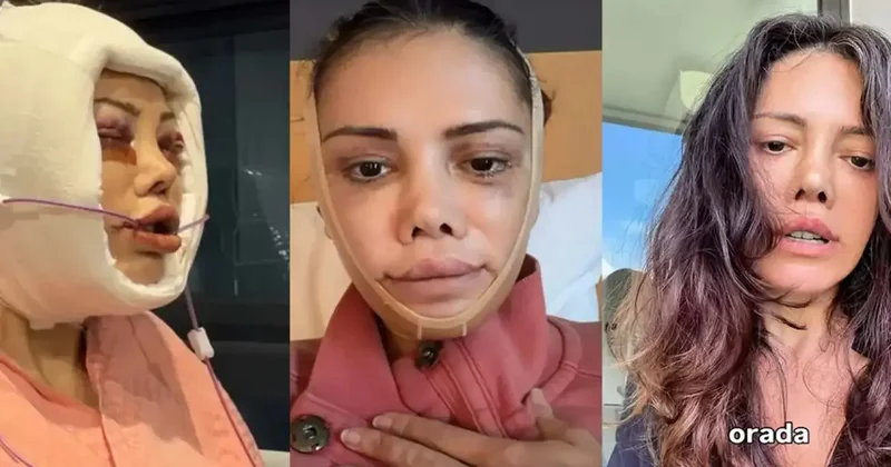 Yüz nakli geçiren Didem Ceran ateş püskürdü: İnsanlar neden yaraya tuz basar?