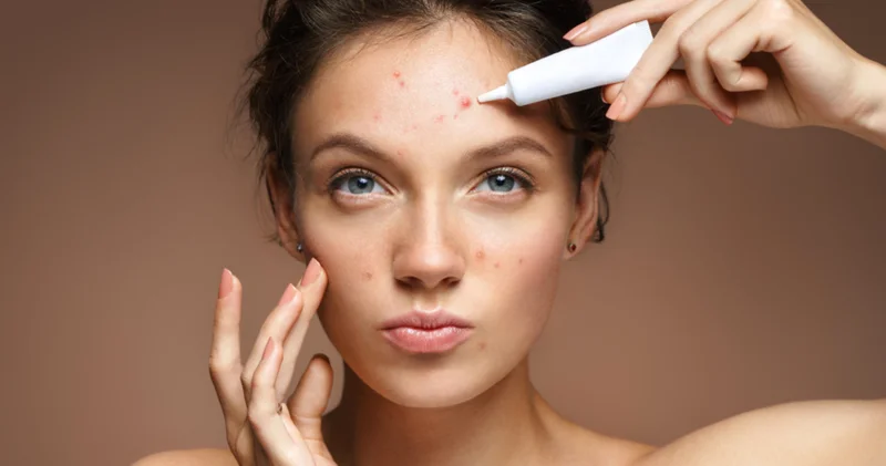 Kurtulmaya çalışırken daha kötü hale getiriyor olabilirsiniz! Akneyi daha kötü hale getiren 10 alışkanlık