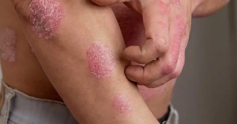 ‘Sedef hastalığı artık yüzde yüz iyileşiyor’