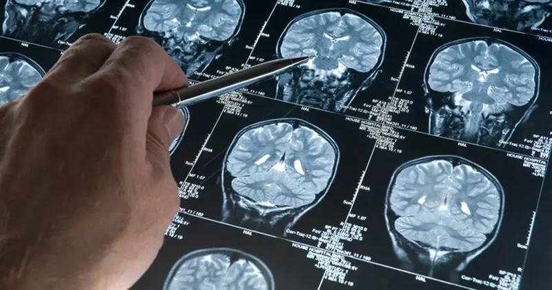 Alzheimer hastalığında yeni gelişme! Beyindeki damarları korumak mümkün olabilir