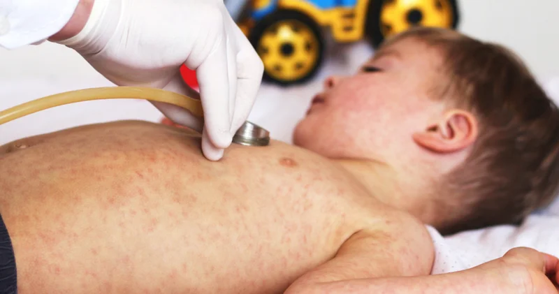 Çocuklarda kronik ürtiker uyku ve yaşam kalitesini düşürüyor Sağlık Haberleri