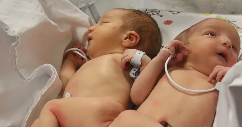 Depremde öksüz ve yetim kalmışlardı: Siyam ikizlerini 9 yaşında ölüm ayırdı!