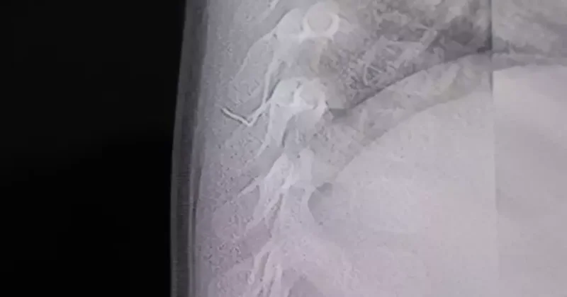 Sırt üstü yatınca ağlıyordu! 1 yaşındaki bebeğin vücudundan çıkan cisim şoke etti