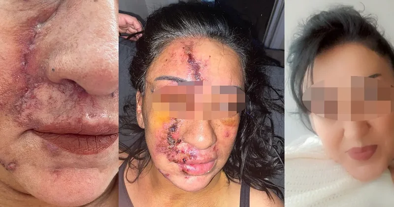 Yine estetik faciası