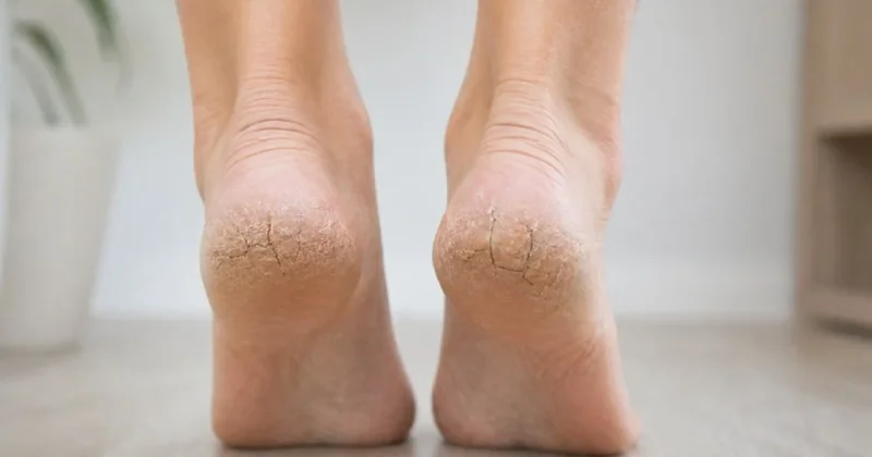 Topuk çatlaklarından kurtulmanın en basit yolu belli oldu: Sadece 15 dakika bekletmek yetiyormuş Sözcü Gazetesi