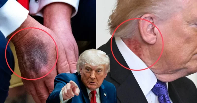 Herkes o morlukları ve lekeleri konuşuyordu: Trump’ın sağlık raporunda şaşırtan 14 yıl detayı Dünya Haberleri