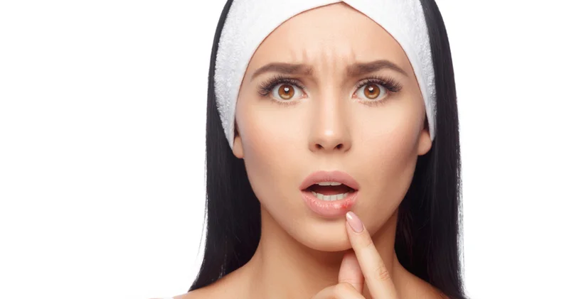 Tahta kaşık bastır diyen de var sarımsak sür diyen de... İşte tekrarlayan uçuklarla baş etmenin yolları