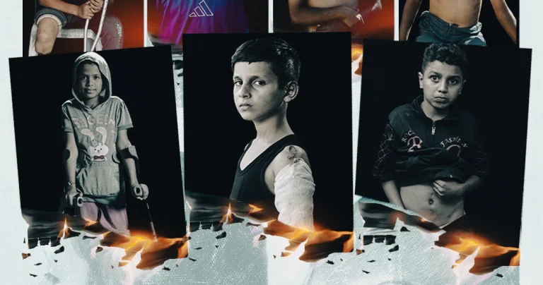 Gazzeli çocuklar, vücutlarında İsrail soykırımının izlerini taşıyor