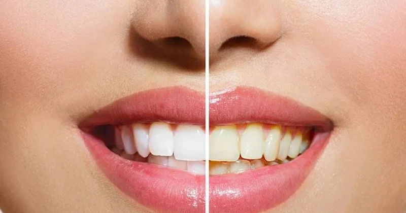 Sararmış dişleri inci gibi beyazlatan meyve: Elma veya portakal değil Sözcü Gazetesi