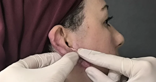 Muş ta bir ilk: Kulak keloidi, ödüllü cerrahi teknikle tedavi edildi Muş Haberleri