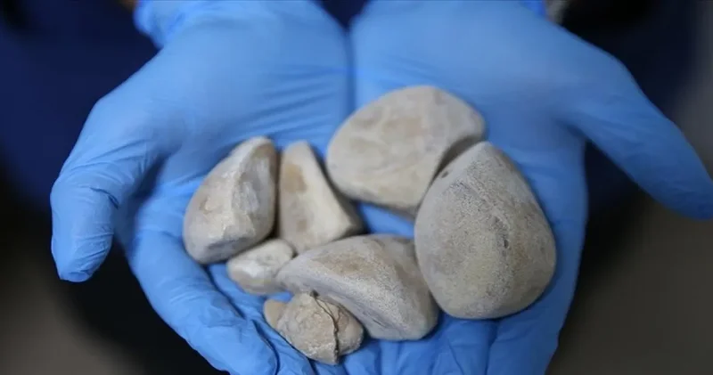 8 yıl boyunca ilaç verip gönderdiler: Engelli yurttaşın vücudundan yarım kilo taş çıktı!