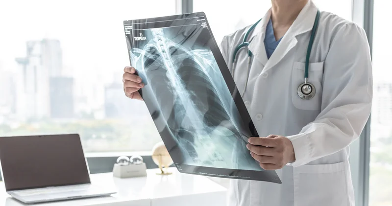 Akciğer kanserinde beslenme, bağışıklığı etkiliyor Sağlık Haberleri