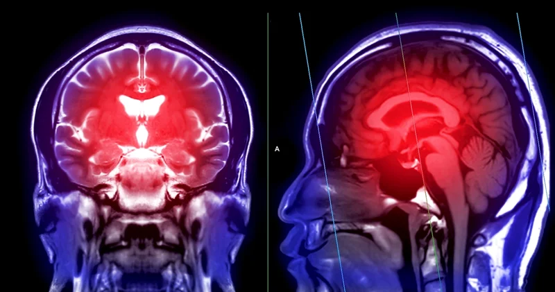 İnme riski gençlerde de artıyor Sağlık Haberleri