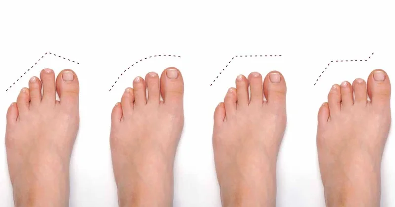 İşte ayak şeklinize göre karakteriniz Sözcü Gazetesi