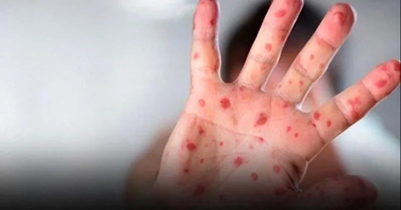 Virüs hızla yayılıyor! Tüm dünya teyakkuzda Sözcü Gazetesi