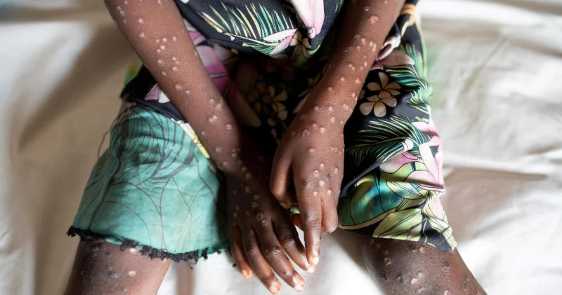 Madagaskar da ilk mpox vakaları: Mahajanga da beş kişide tespit edildi Dünya Haberleri